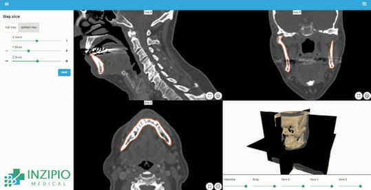 (Bild 2: Mithilfe von künstlicher Intelligenz werden CT-Daten durch Inzipio automatisiert zu 3D-Daten aufbereitet. Diese ermöglichen eine vollständige digitale Operationsplanung, sodass auch komplexe Rekonstruktionen möglich werden. Bild: Inzipio)
