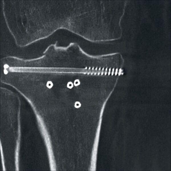In der Orthopädie können Metallimplantate auf dem Röntgenbild in hoher Qualität dargestellt werden. (Ziehm Imaging)