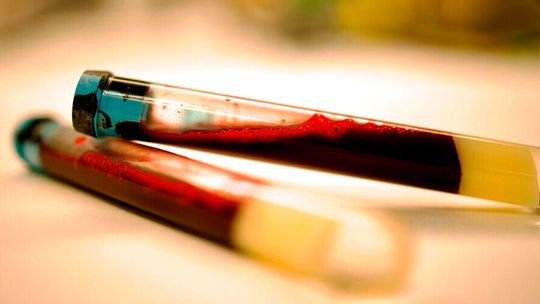 Researchers have succeeded in identifying biomarkers for Parkinson’s disease in its earliest stages, before extensive brain damage has occurred. (Source:  Nicola Pietro Montaldo)