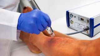 Der Plasmajet Kinpen Med ist eine Lösungen für die Behandlung von chronischen und akut infizierten Wunden. (Bild: neoplas-med )