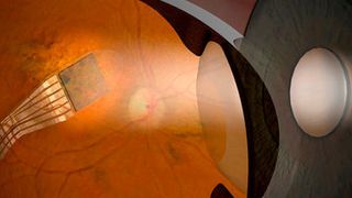 Netzhaut-Chip der Firma Retina Implant im menschlichen Auge: Der drei mal drei Millimeter kleine Chip mit 1500 Fotoelektroden wird unter der Netzhaut platziert und wandelt Lichtreize in elektrische Impulse um. Das Ladungsbild wird dann über den Sehnerv an das Gehirn geleitet. Die Stromversorgung erfolgt über eine dünne Leitung (unten rechts im Bild), die zu einer am Hinterkopf unter der Haut angebrachten Spule führt. (Retina Implant AG)