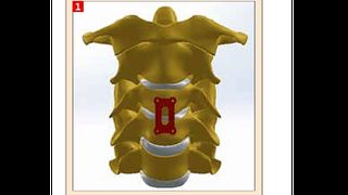 Fig. 1 Schematic representation of cervical spine with fusion plate made by (HDPE) composite. (Bild: )