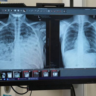 Lung cancer patient scans before and after transplant. (Source: Northwestern University )