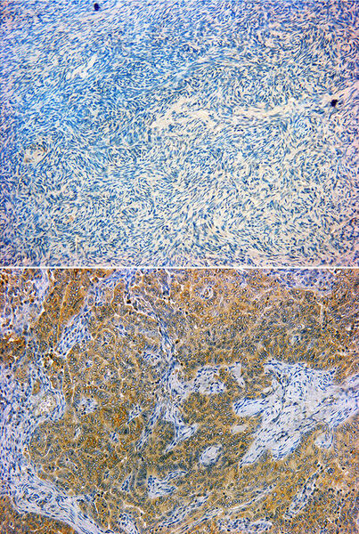 Das Bild oben zeigt das menschliche Eierstockgewebe: Die blauen Färbungen sind die einzelnen Zellkerne. Die braune Färbung auf dem Bild unten zeigt die Aktivierung eines Gens der endogenen Retroviren. (Bild: PD Dr. Strissel/PD Dr. Reiner Strick)