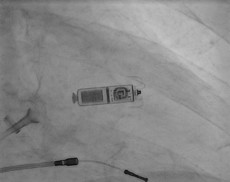 Implantation der Kardiokapsel im Röntgenbild (Bildmitte). Unten ist eine nicht mehr funktionsfähige Schrittmacherelektrode zu erkennen.
 (UMG/Dr. Mathias Busch)