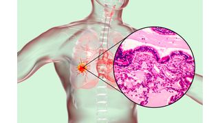 Für die Krebsdiagnose und die Auswahl der richtigen Therapie müssen die Vorgänge in Tumoren auf kleinster Ebene verstanden werden. (Symbolbild) (Bild: © Dr_Microbe - stock.adobe.com)