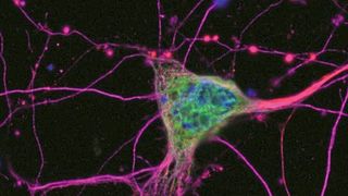 Bei der ALS sterben Nervenzellen ab, die für die Muskelsteuerung verantwortlich sind. (Universitätsklinik Ulm für Neurologie Ulm/RKU)