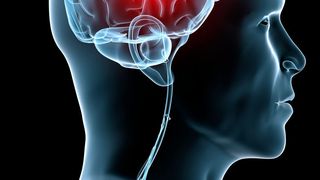 Eine Meta-Studie liefert neue Erkenntnisse über genetische Risikofaktoren für einen Schlaganfall. (©Sebastian Kaulitzki - stock.adobe.com)