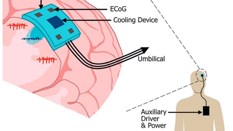 Der Prototyp kombiniert ECoG-Aufzeichnung mit fokaler Hirnkühlung. Seine 3D-gedruckte Silikonstruktur enthält fluidische Kanäle und ist mit diskreten elektronischen Komponenten bestückt.(Bild:   Moore et al. (2026))