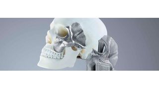 Der Medizintechnik-Hersteller Conmet produziert mit einem 3D-Drucker von Trumpf Schädel- und Kieferimplantate. (Trumpf)