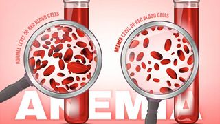 Blutarmut (Anämie) kann eine Folge von Eisenmangel sein. (Bild: Double Brain - stock.adobe.com)