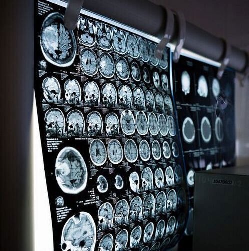 Routine brain scanning in people experiencing psychosis could help to identify underlying physical conditions that are causing their symptoms, according to a new study. Routine brain scanning in people experiencing psychosis could help to identify underlying physical conditions that are causing their symptoms, according to a new study.