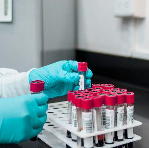 UT Southwestern researchers have developed a simple blood test to predict which Nafld patients are most likely to develop liver cancer. UT Southwestern researchers have developed a simple blood test to predict which Nafld patients are most likely to develop liver cancer.