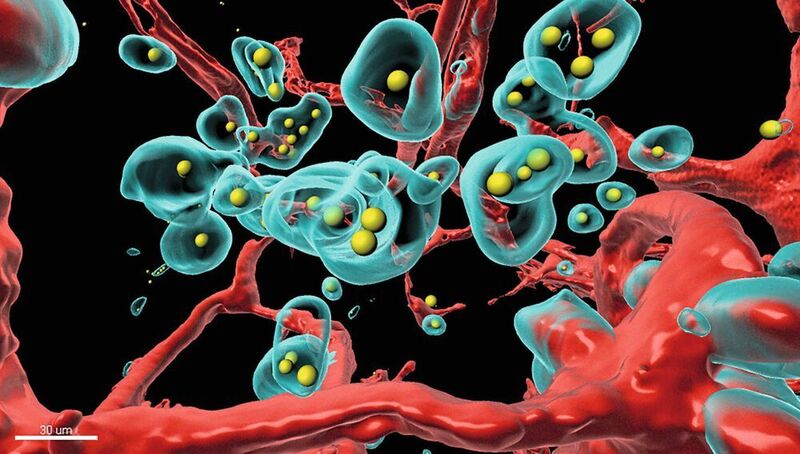 Ein Stück des Tumors wurde durchsichtig gemacht und in 3D durchsucht. Die mit fluoreszierenden Farben markierten Bestandteile wurden am Computer in eine 3D-Darstellung übertragen (rot: Blutgefässe, türkis: Tumorzellen, gelb: therapeutischer Antikörper). (Copyright (c) 1993-2019, Bitplane AG / Plückthun Lab)