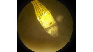 Zu sehen ist hier ein subretinales Alpha IMS Implantat auf dem hinteren Augenpol bei Retinitis pigmentosa. (Bild: Department für Augenheilkunde, Uni Tübingen)