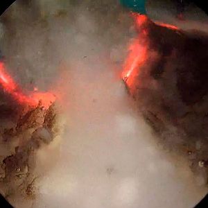 Eine 3D gedruckte Prostata-Attrappe