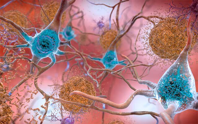 n this artist’s rendering, amyloid plaques are interspersed among neurons. These aggregates of misfolded proteins disrupt and kill brain cells, and are a hallmark of Alzheimer’s disease. (National Institute of Aging)
