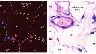 Nachweis von Eosinophilen in menschlichem Bauchfett mittels zwei unterschiedlicher Färbungen. Die Eosinophile sind mit einer Pfeilspitze markiert. AD: Adipozyten (Fettzelle), V: Blutgefäß.  (Bild: © DBMR, Universität Bern, D. Brigger )