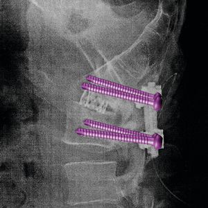 Titanimplantate: Denis During trägt Implantate aus Titan im Rücken. Damit bei diesen Operationen auch die richtigen Elemente zum Einsatz kommen, sind sie eingefärbt.