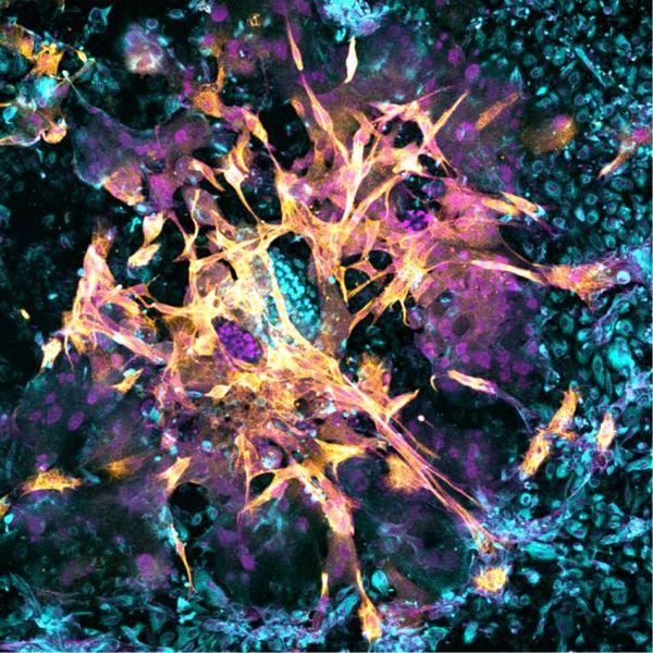 Embryo-Mutter-Interaktion Forscher am Babraham Institute haben ein neues 3D-Kulturmodell entwickelt, das die menschliche Gebärmutterschleimhaut (Endometrium) nachahmt. Dieses System ermöglicht es, die entscheidenden Interaktionen zwischen dem Embryo und dem Endometrium während der Implantation zu untersuchen. Durch die Verwendung von gespendetem Endometriumgewebe und der Isolation essenzieller Zelltypen konnten die Wissenschaftler eine biologisch präzise Nachbildung erstellen.  In Experimenten mit menschlichen Embryonen beobachteten die Forscher, dass diese die erwarteten Phasen der Implantation durchliefen und begannen, wichtige Schwangerschaftsmarker wie hCG zu produzieren.  Die Erkenntnisse aus diesem Modell könnten dazu beitragen, die Ursachen von Unfruchtbarkeit und frühen Schwangerschaftskomplikationen besser zu verstehen. Darüber hinaus ermöglicht das Modell die Untersuchung individueller Reaktionen des Endometriums auf den Embryo, was letztlich zu verbesserten Behandlungsansätzen führen könnte.   Das Bild zeigt ein Mikroskopiebild eines 14 Tage alten menschlichen Embryos, der in das neue Endometrium-Modell implantiert wurde. Die hellblauen Zellen in der Mitte des Bildes sind unspezialisierte Epiblastenzellen, aus denen später alle Gewebe des Körpers entstehen. Die orangefarbenen Zellen sind Trophoblastenzellen, die später die Plazenta bilden werden. Die blauen Zellen, die den Embryo umgeben, sind Endometriumzellen, die die Implantation und das Wachstum des Embryos unterstützen.  Hier gehts zur OriginalmeldungWissenschaftsbild des Tages vom 13.1.2026  (Bild: Matteo Molè at the Babraham Institute)