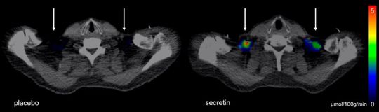 Bildgebende Verfahren zeigen, wie braunes Fett in einem Depot über dem Schlüsselbein durch das Hormon Sekretin stimuliert wird. (Bild:  S. Laurila)