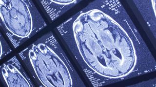 Glioblastome wachsen oft unbemerkt und symptomfrei. Ihre Behandlung ist schwierig. (Symbolbild) (© jawphotos, Getty Images via canva.com)