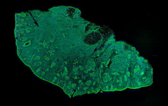 Falschfarben-RGB-Bild einer cm-großen Gewebeprobe, gemessen mit der Zwei-Photonen-Bildgebung. Grün ist eine fluoreszierende Proteinfärbung, rot ist eine DNA-Färbung und blau ist SHG in geordnetem Kollagengewebe. Dieses Bild wurde aus Hunderten von Bildern mit subzellulärer Auflösung zusammengesetzt, die in insgesamt weniger als einer Minute aufgenommen wurden. Falschfarben-RGB-Bild einer cm-großen Gewebeprobe, gemessen mit der Zwei-Photonen-Bildgebung. Grün ist eine fluoreszierende Proteinfärbung, rot ist eine DNA-Färbung und blau ist SHG in geordnetem Kollagengewebe. Dieses Bild wurde aus Hunderten von Bildern mit subzellulärer Auflösung zusammengesetzt, die in insgesamt weniger als einer Minute aufgenommen wurden.