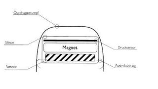 Magnetic Esophageal Advancement. (DPMA)