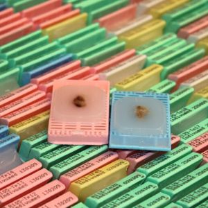 Abb.1: Die Biodatenbank von Indivumed umfasst biologische Proben von mehr als 15.000 Krebspatienten.