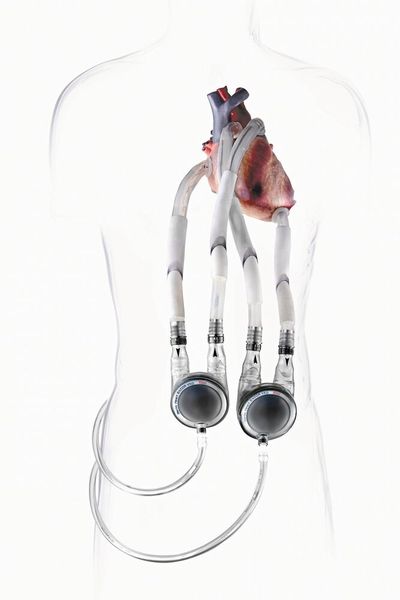  (Bild: Berlin Heart GmbH)