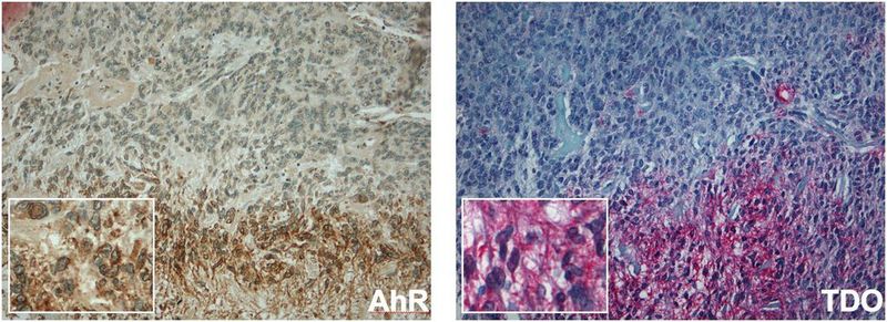 Im Hirntumorgewebe kann sowohl das Enzym TDO (rot) als auch der Dioxin-Rezeptor AHR (braun) in denselben Arealen nachgewiesen werden. (Färbung: Felix Sahm, Abteilung Neuropathologie, Universitätsklinikum Heidelberg)  (Bild: Nature)