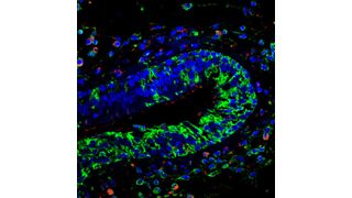Immunhistologische Färbung von Gewebe eines Nasenpolypen: In Epithelzellen und Entzündungszellen (Zellkerne in blau) sind Komponenten der Leukotrien-Kaskade aktiv (grün: LTC4 Synthase, rot: cysteinyl Leukotrien-Rezeptor 1). (Helmholtz Zentrum München)