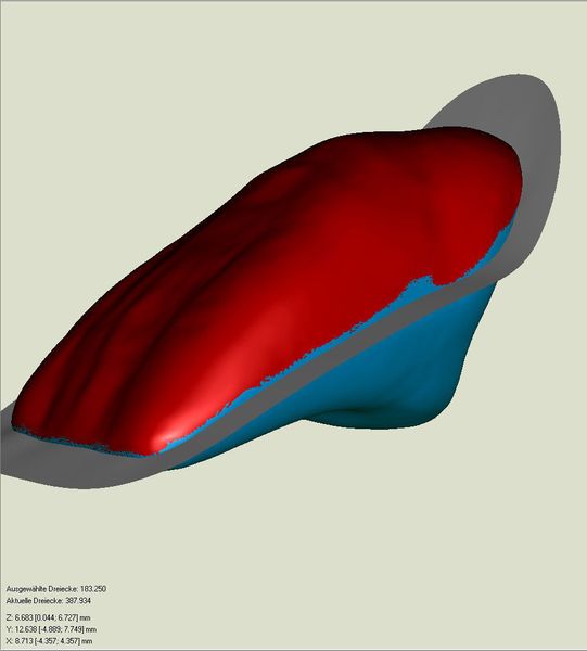 Bild 5: Im 3D-Modell der Zähne wird die Dichtfläche der Formenhälften  anhand der Trennlinie konstruiert. Die rote Färbung zeigt die Ideallinie, um einen Hinterschnitt zu vermeiden. Bild: Heraeus Kulzer (Archiv: Vogel Business Media)