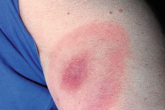 Bei einem solchen roten Kreis ist umgehend ärztlicher Rat aufzusuchen: Wanderröte (Erythema migrans) ist ein frühes Symptom einer Borrelien-Infektion(Bild:  CDC/James Gathany (Public domain))