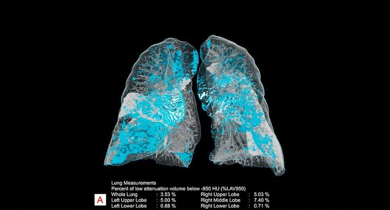 CT-Aufnahme der beiden Lungenflügel mit KI-unterstützter automatischer Hervorhebung, Quantifizierung und Vermessung von Anatomie und Abweichungen. (Siemens Healthineers)