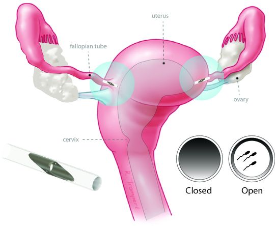 Schematische Darstellung des mikro-mechanischen Implantats von Choice im Eileiter, das auf einem miniaturisierten Ventilmechanismus basiert.(Bild:  Choice/Meko)