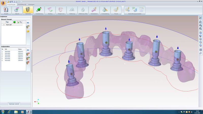 WorkNC Dental enthält unter anderem eine Standard-Bibliothek von Bearbeitungsfolgen, die speziell für die Morphologie prothetischer Rekonstruktionen entwickelt wurden.  (Bild: Sescoi)