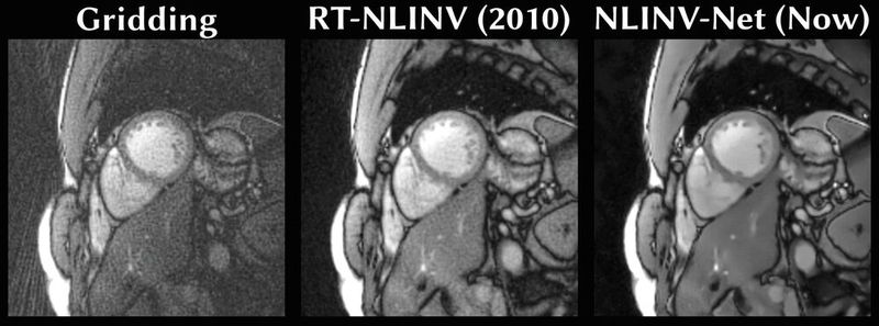Kurzachsenschnitt durch das Herz: Gegenüberstellung der einfachen MRT-Bildrekonstruktionsmethode «Gridding» (links), der 2010 entwickelten Methode «RT-NLINV» (Mitte) sowie der neuen Methode «NLINV-Net» (rechts), bei der die Modellierung von RT-NLINV mit maschinellem Lernen kombiniert wird, was eine wesentlich schnellere und weiter verbesserte Bildrekonstruktion ermöglicht.  (Bild: TU Graz – Institute of Biomedical Imaging)