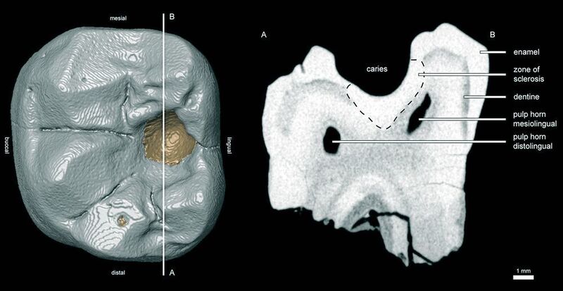 Links: 3D-Rekonstruktion eines Zahnes von D. carinthiacus. Die braun gefärbte Stelle zeigt den Kariesbefall. Rechts: Mikro-Computertomogramm des kariesbefallenen Zahns. (Jochen Fuß, PLoS ONE, 2018)