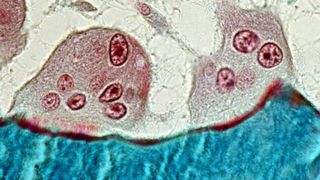 Feingeweblicher Schnitt vom Knochen eines Osteoporose Patienten. Zu sehen sind zwei Osteoklasten (mehrkernige Zellen), die den Knochen (blau) gerade zerstören.  (Bild: UKE)