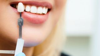 Zahnersatz soll natürlich aussehen, robust also hochfest sein und dazu noch schnell anzufertigen. (Symbolbild)  (Aleksandr Rogulin)