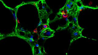Das Molekül Wnt5a ist verantwortlich dafür, dass bei COPD Patienten Strukturen der Lunge (hier dargestellt das Lungenbläschen-Epithel in Grün und Immunzellen in Rot) nicht mehr heilen. (HMGU)