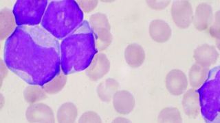 It is hoped that the findings will pave the way for new and more personalised therapies for acute myeloid leukaemia. (Getty Images )