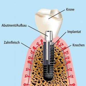 Aufbau eines Implantats: Im Knochen verankert ist der Implantatkörper, das Abutment oder Verbindungsstück (Schraube), und oben die Zahnkrone. Bild: implantate.com