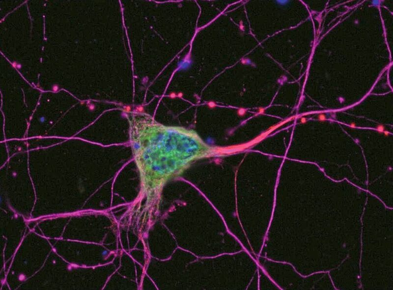 Bei der ALS sterben Nervenzellen ab, die für die Muskelsteuerung verantwortlich sind. (Universitätsklinik Ulm für Neurologie Ulm/RKU)