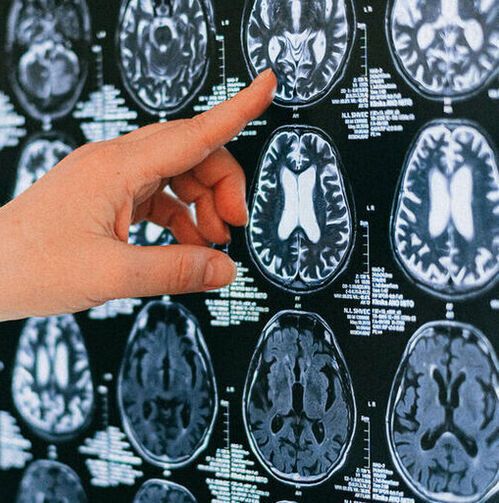 Generic image of a brain MRI scan. (Source:  Anna Shvets from Pexels)