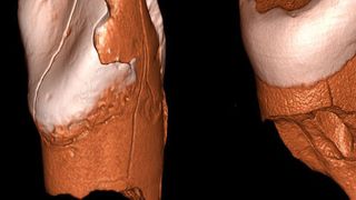 Dreidimensionale digitale Modelle des unteren Schneidezahns aus Riparo Bombrini (links) und des oberen Schneidezahns aus der Grotta di Fumane (rechts). Bei beiden Zähnen handelt es sich um Milchzähne (Ausschnitt). (Bild: Daniele Panetta)