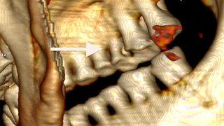 Blick auf die rechte Seite der Zahnreihen (3D-Rekonstruktion). Pfeil nach rechts: tiefe kariöse Läsionen, Pfeil nach links: starker Knochenschwund der Backenzähne (Bild: UZH)