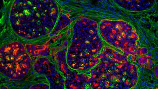 Early-stage breast cancer tumours are separated from their environment by a basement membrane that acts as a biological barrier. In the picture, localised cancer tumours (nuclei blue and cells partly red) are surrounded by the basement membrane (green).  (Source: Guillaume Jacquemet, Åbo Akademi)