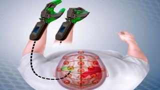 Diagramm der sogenannten "Ipsihand" im Einsatz: Das Gerät spürt Impulse im unbeschädigten Bereich des Schlaganfallpatienten (grün dargestellt), was dazu führt, dass sich die Plastikschiene an der Hand entsprechend öffnet und schließt. Durch stetige Wiederholung hilft die Ipsihand die heilen Gehirnbereiche zu trainieren und nach und nach Funktionen zu übernehmen, die zuvor von den durch den Schlaganfall beschädigten Hirnzellen durchgeführt wurden. (Matthew Holt / Sara Moser / Washington University School of Medicine )